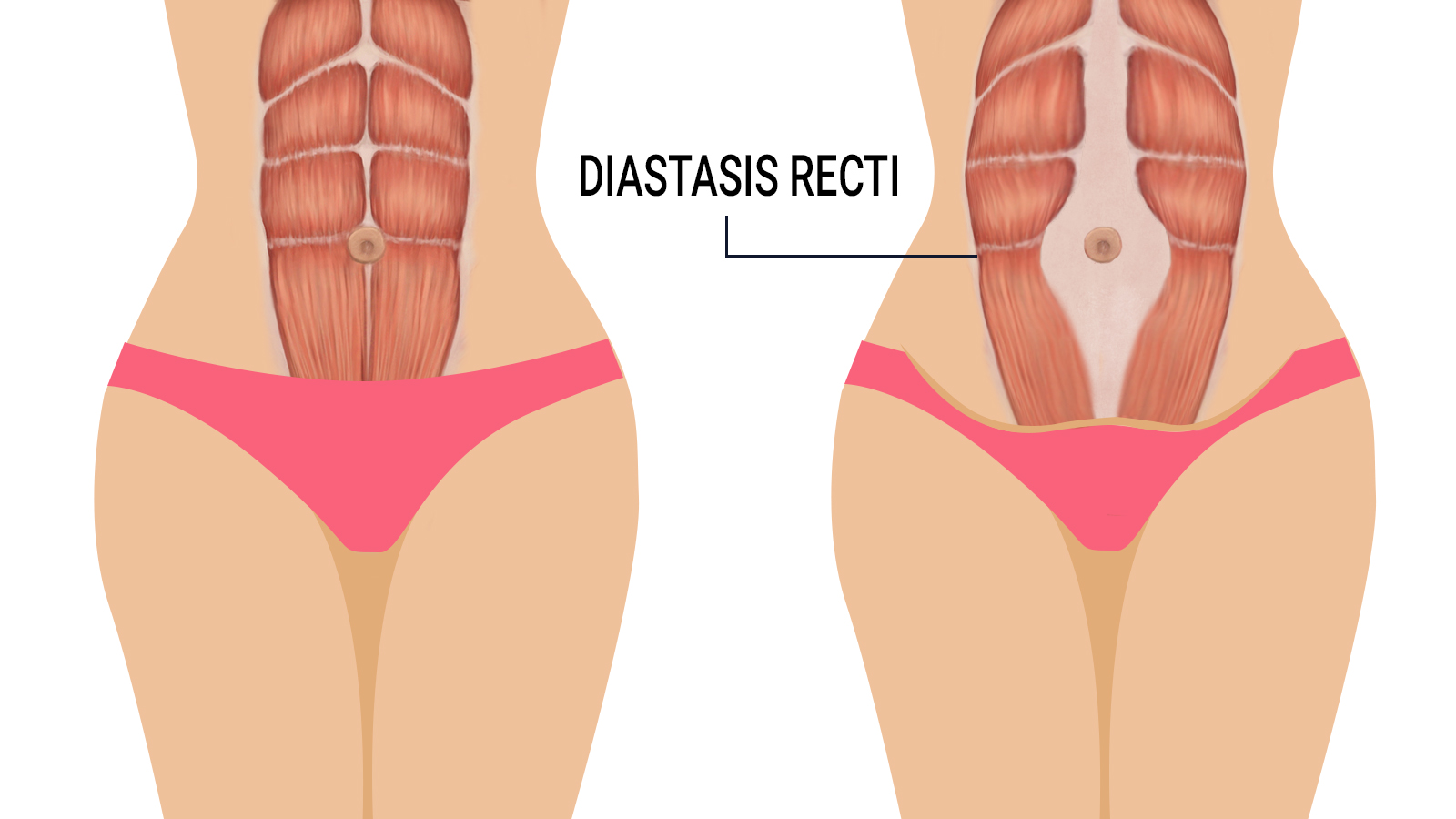 Abdominal separation (diastasis recti) during pregnancy
