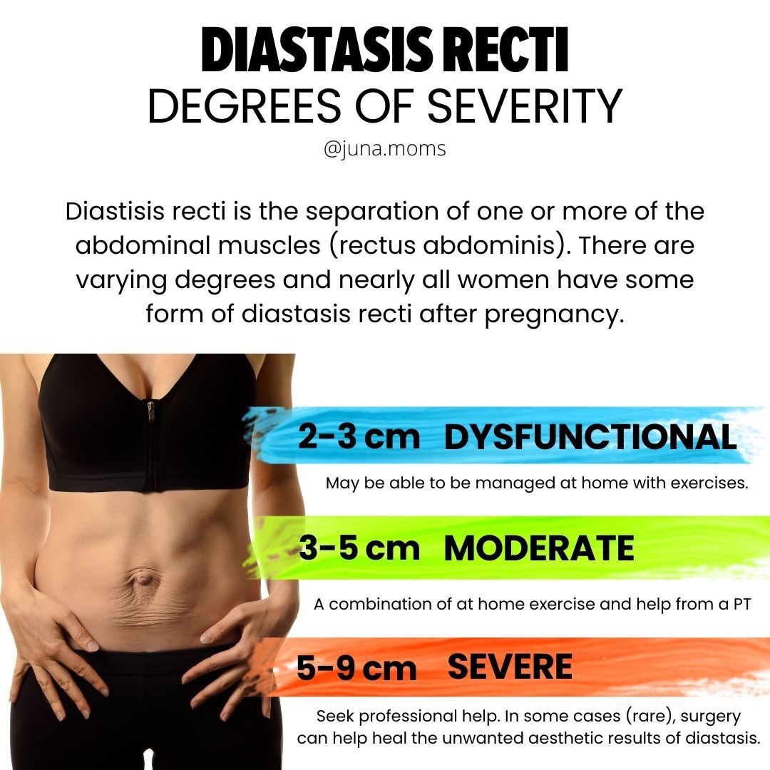 degrees of diastasis recti